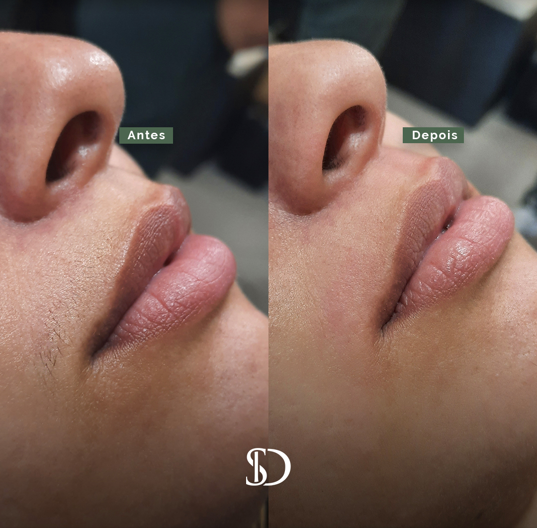 Story – Antes e depois – 2 (1)